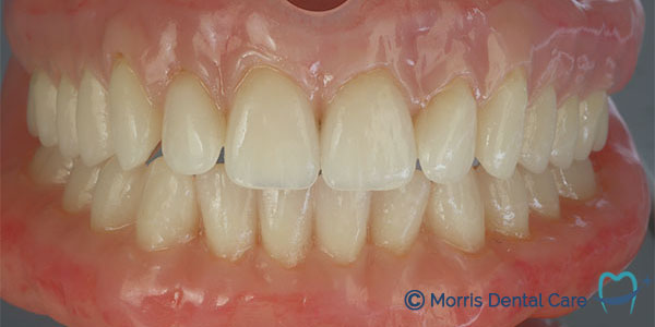 Before treatment the patient had crowded teeth which inhibited good oral care (teeth cleaning)